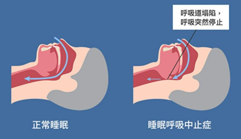 失眠、打鼾、嗜睡？ 睡眠「呼吸中止症」病因 年齡大不同