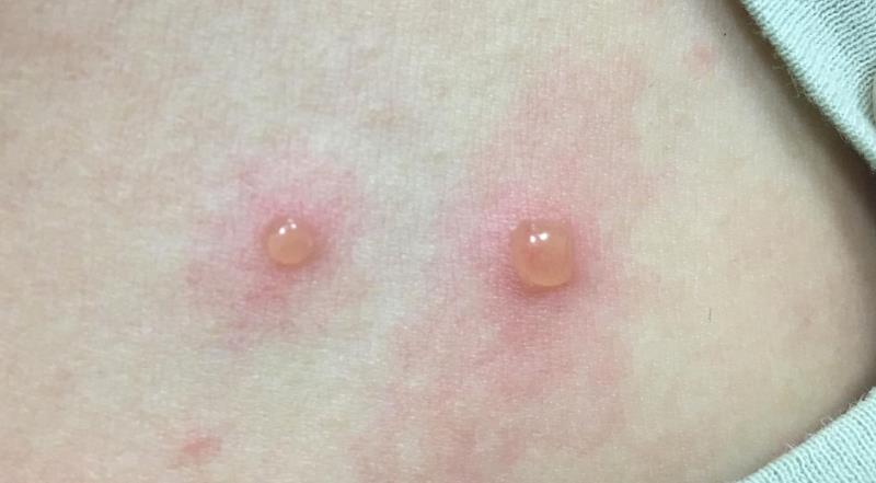 縣內水痘病例陸續發生! 衛生局呼籲留意幼童健康衛生 小心不要成為「痘痘」龍       