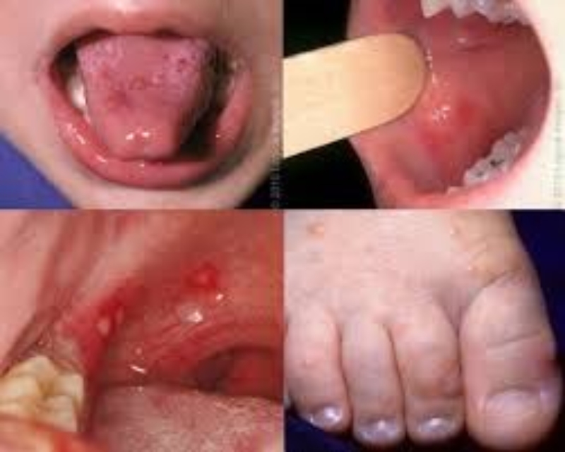 新增1例10個月大男嬰腸病毒重症，疾管署籲家長嚴防疫情