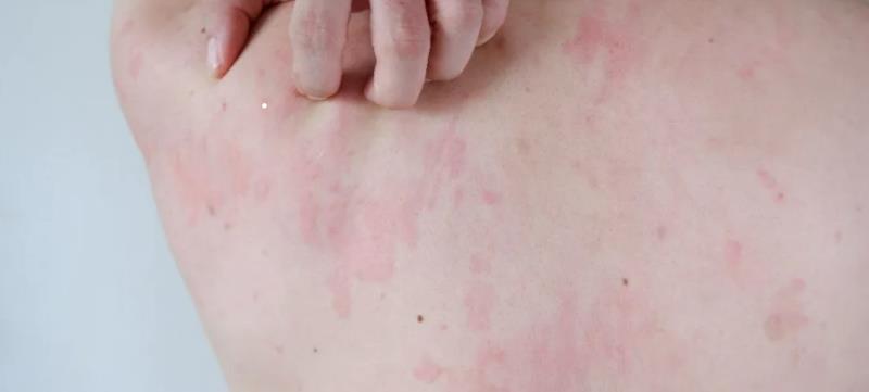 麻疹群聚再添7例確診 疾管署籲接種疫苗強化防護