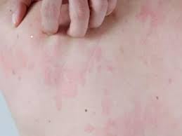 新增麻疹病例集中醫院接觸者 疫情未擴大 公費MMR疫苗充足