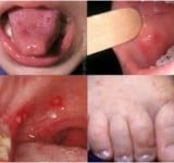 國內新增2例腸病毒感染併發重症病例 請家長及教托育機構落實腸病毒防疫措施